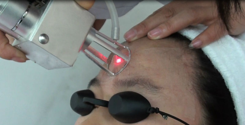 laser treatment